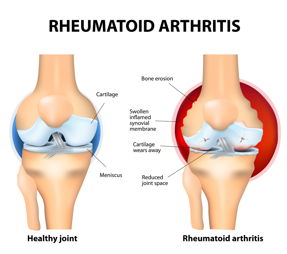 can methotrexate cause joint pain