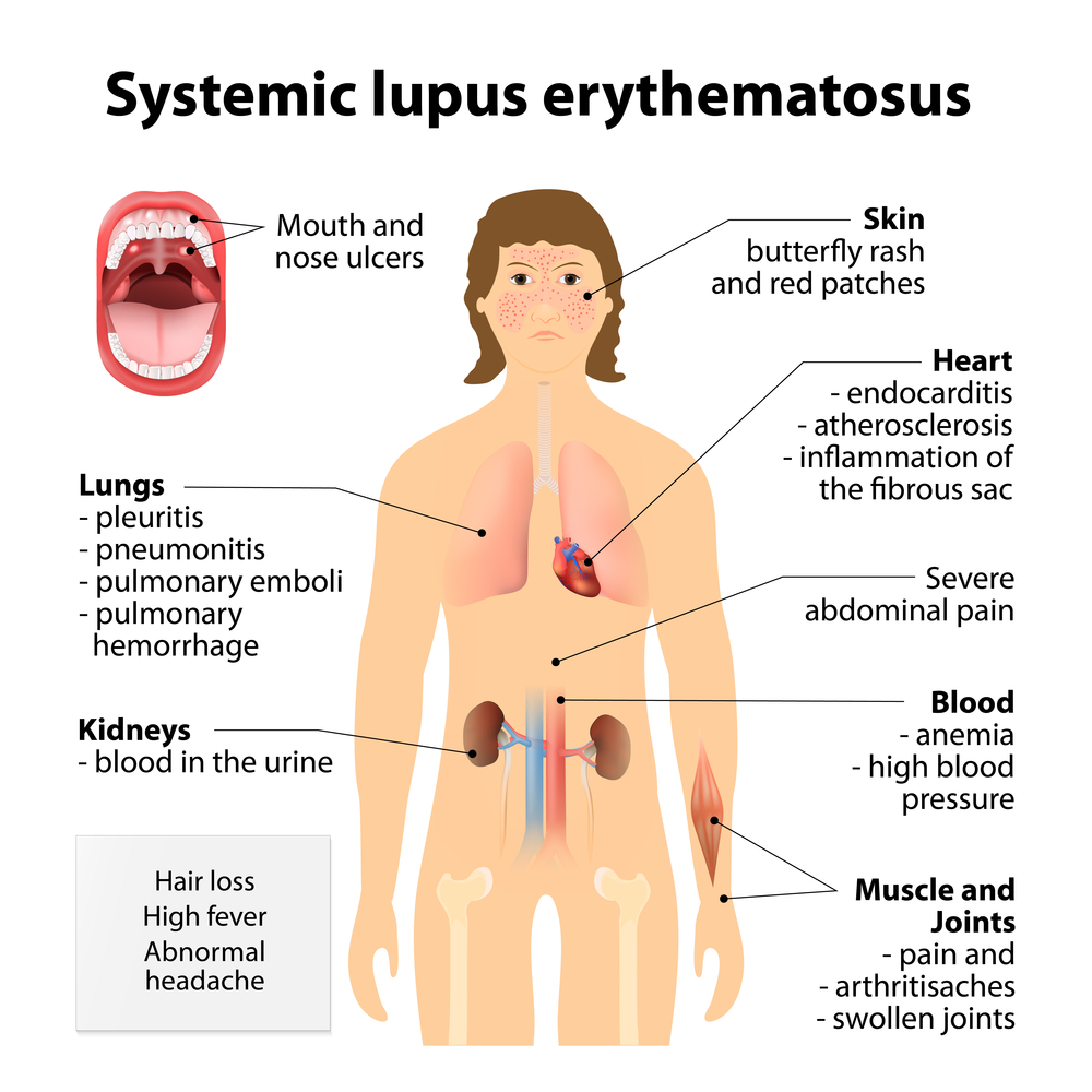 Systemic Lupus Erythematosus - Houston, TX - Rheumatology & Infectious