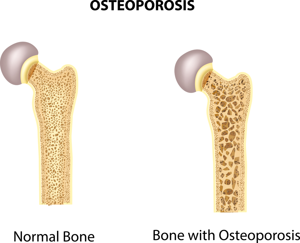 Osteoporosis Houston, TX Rheumatology & Infectious Diseases